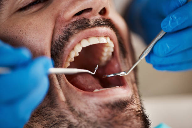 Best Wisdom Tooth Removal  in Middlebranch, OH